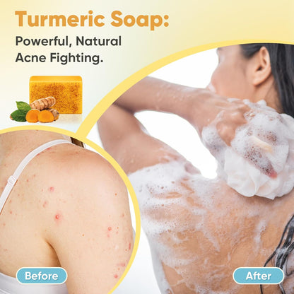 2 Pack Turmeric Soap, 100g Kojic Acid and Turmeric Soap Bar