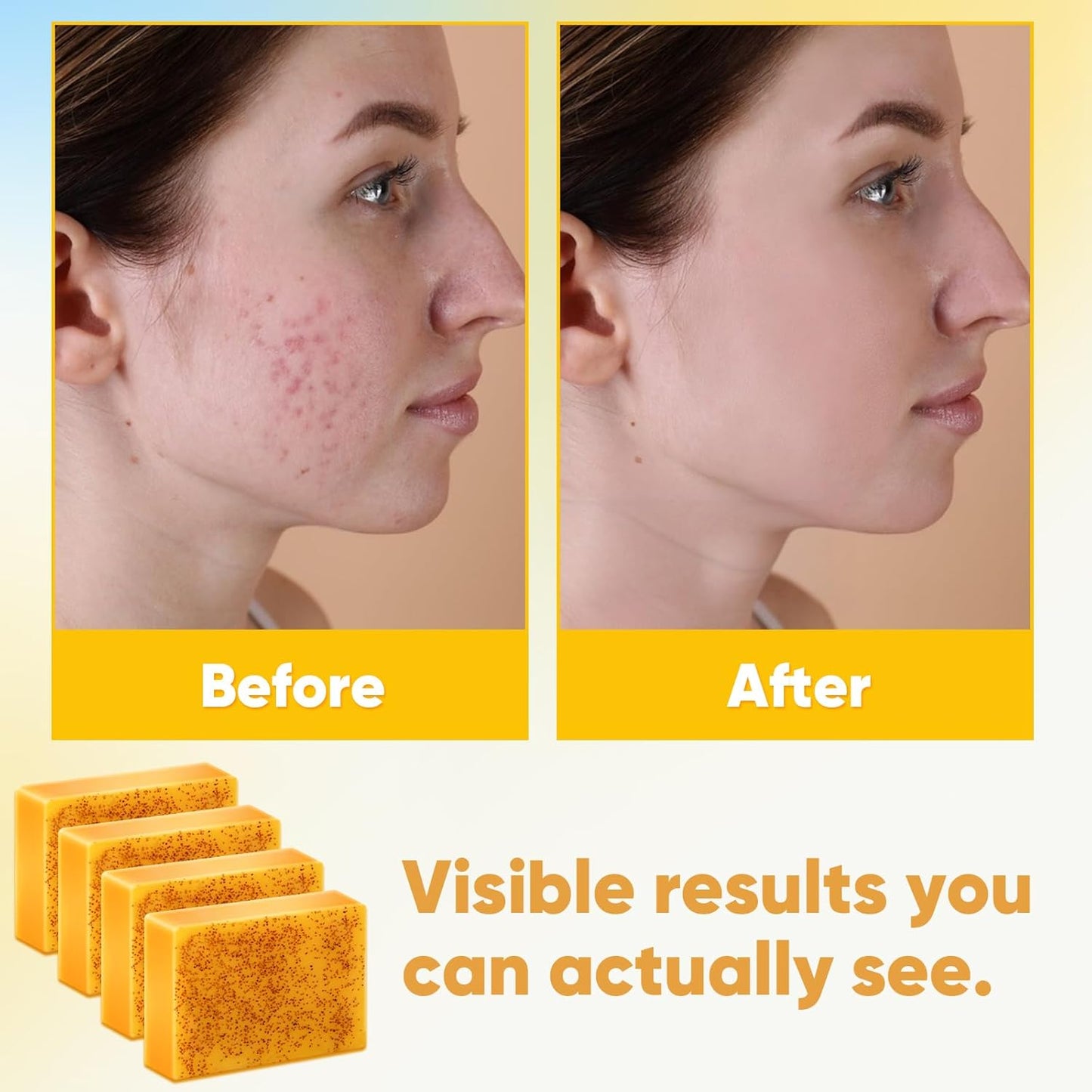 2 Pack Turmeric Soap, 100g Kojic Acid and Turmeric Soap Bar