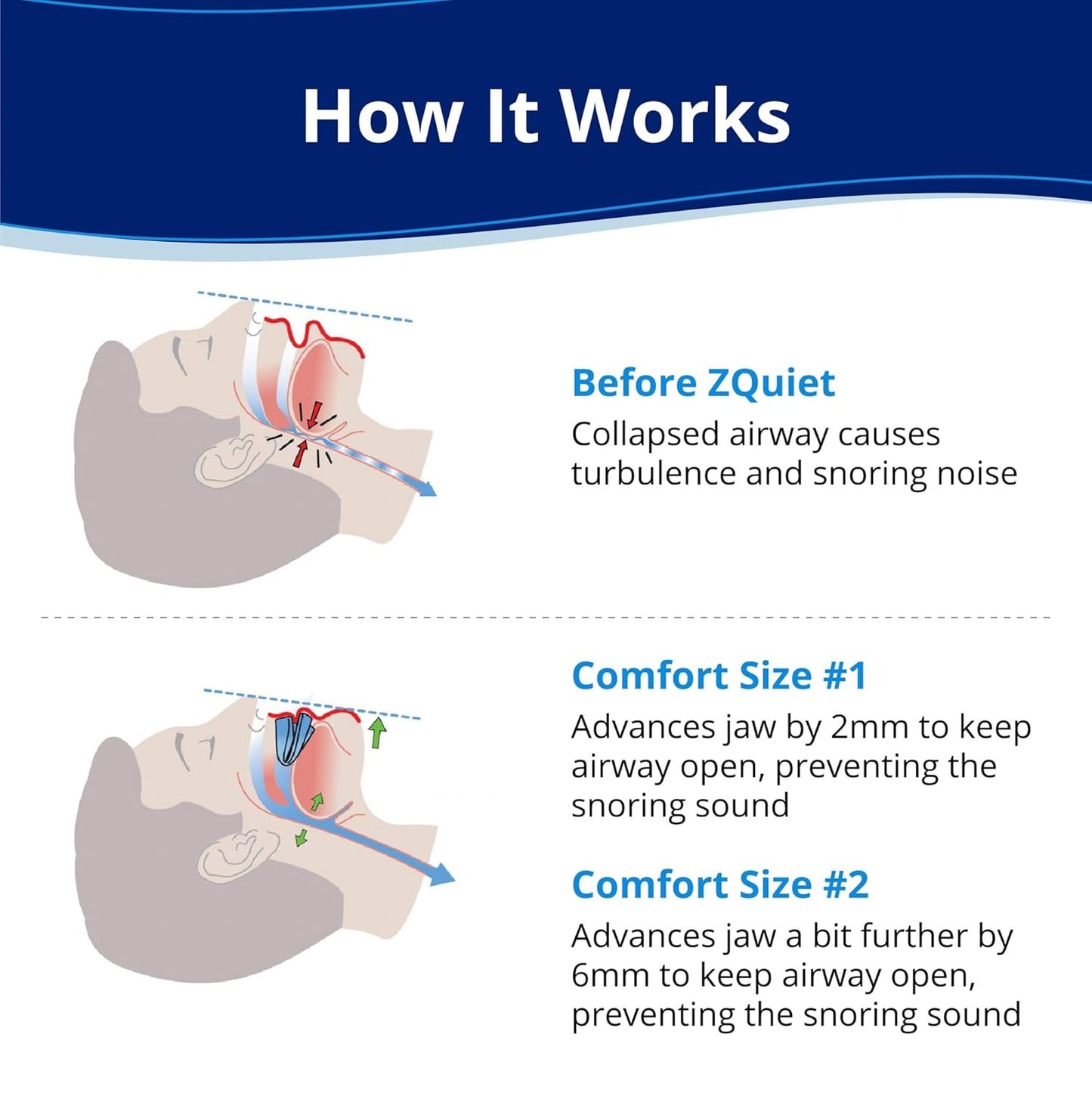 Sleep Care Braces - Gentle Care for Nighttime Sleep and Snoring Protection