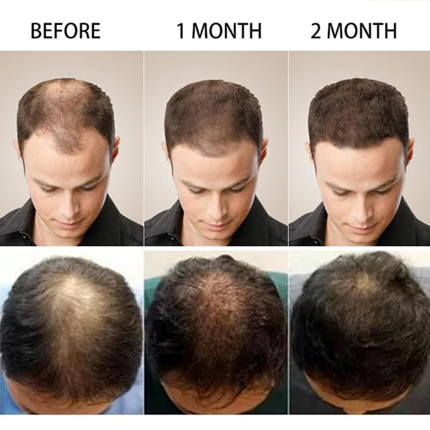 5% Minoxidil Hair Growth Scalp Massage Cream
