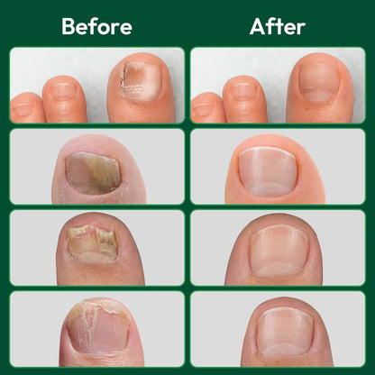 Nail Care Patches 16 Sheets Overnight Nail Wraps for Thick Discolored Nails